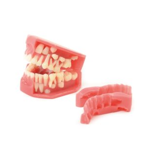 Model zubů dítěte s odnímatelnými dásněmi