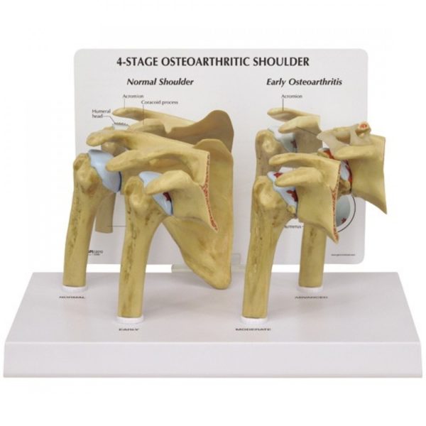 model osteoartrózy