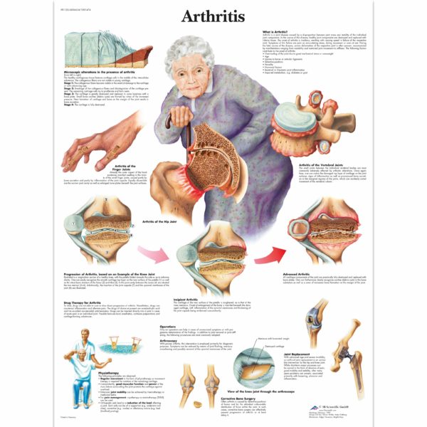 Zalaminované schéma artritidy