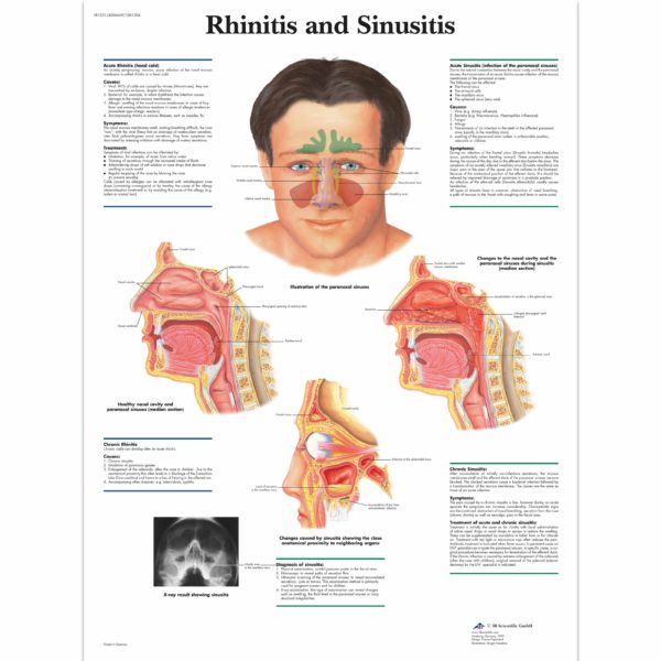Zalaminované schéma rhinitidy a sinusitidy