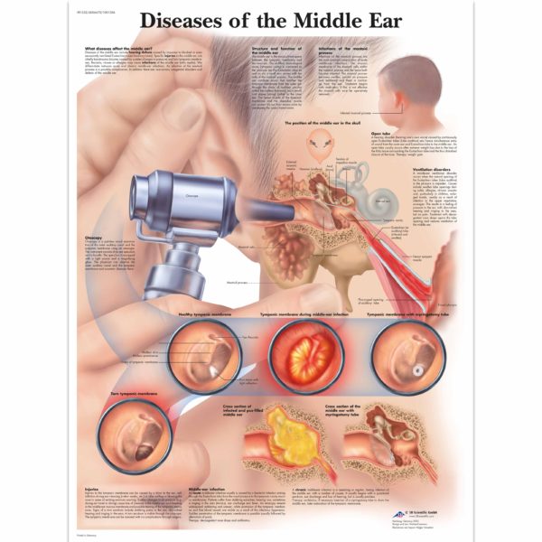 Zalaminované schéma onemocnění středního ucha