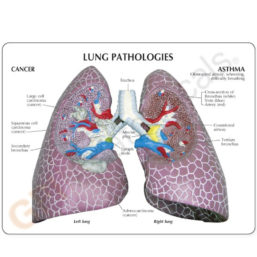 Anatomický model poškozených plic