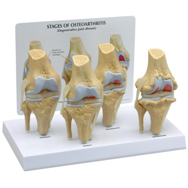 Osteoartritida kolenního modelu (4 stupně)
