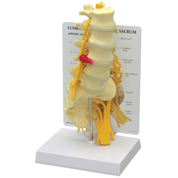 Anatomický model bederní páteře a vyhřezlé ploténky