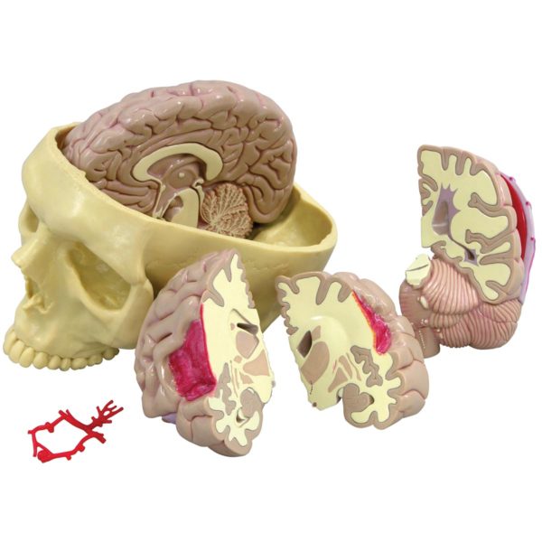 Model lidského mozku s onemocněním
