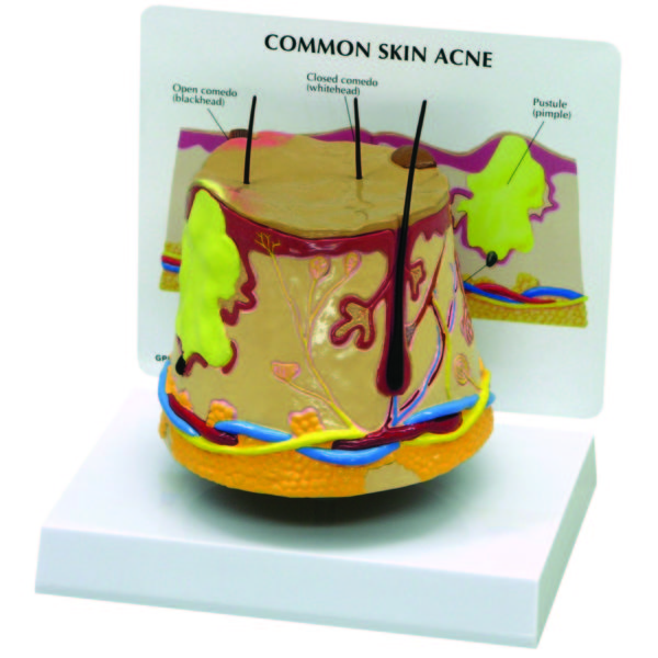 Anatomický model akné