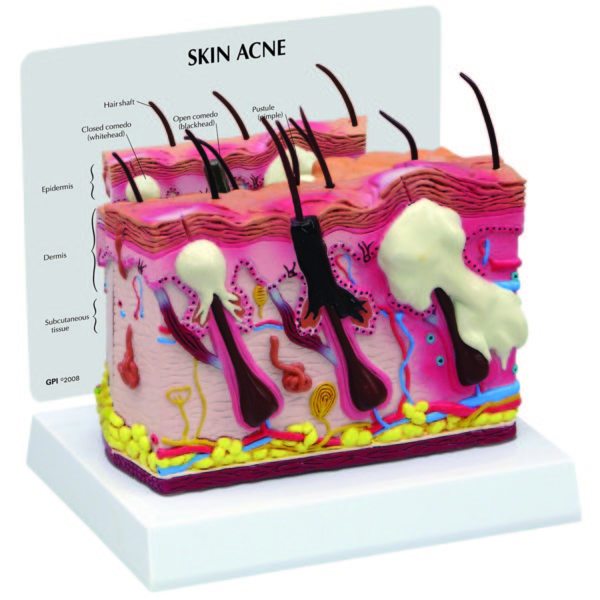 Anatomický model akné a zdravé kůže