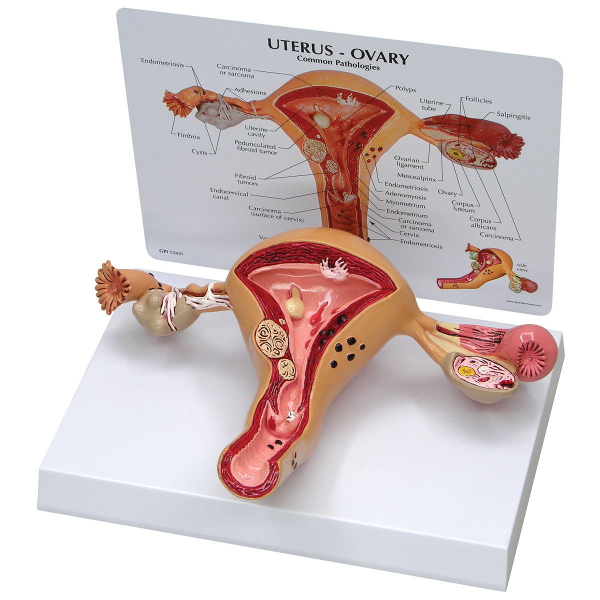 Model nemocné dělohy