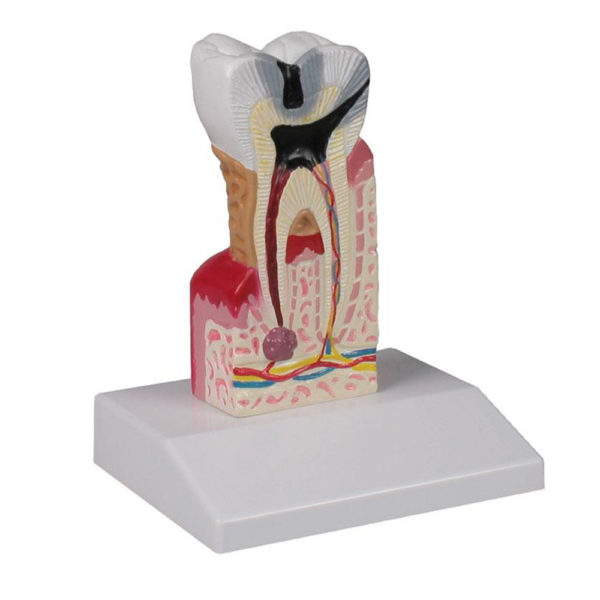 Model zubního kazu (10x životní velikost)