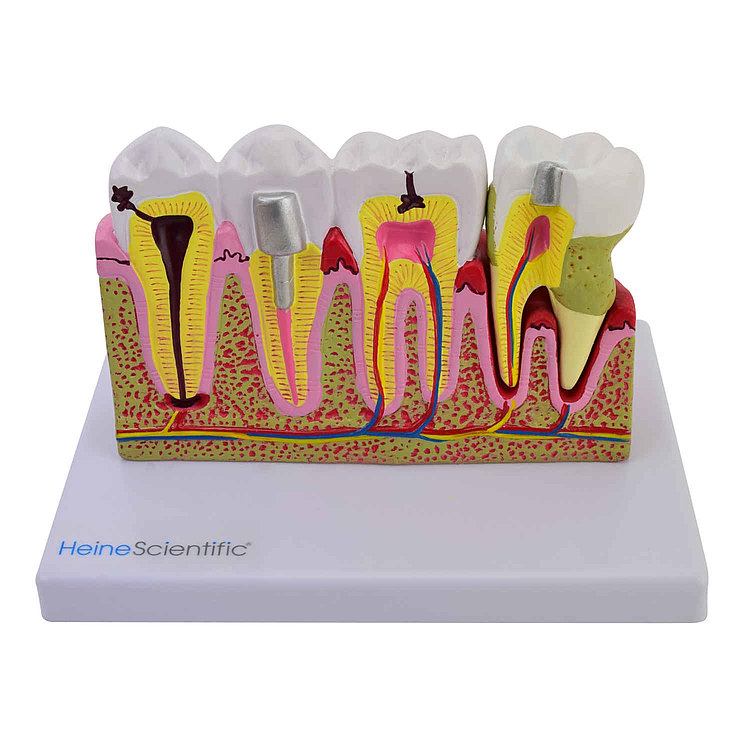 Zubní onemocnění stoliček a třenových zubů
