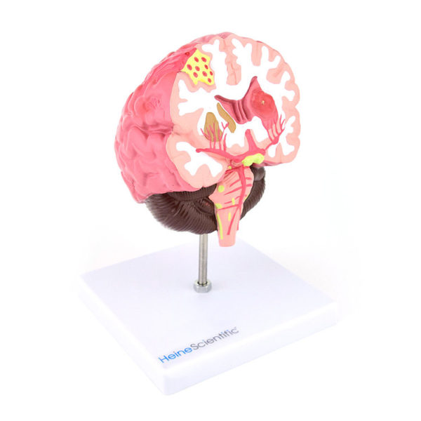 Anatomický model lidského mozku se zobrazením nejčastějších cévních onemocnění